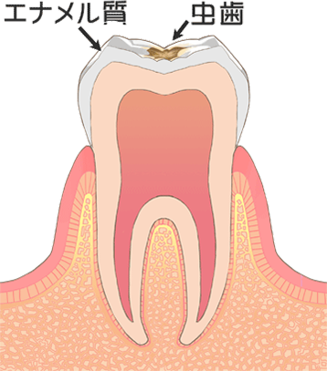 C1［初期の虫歯］