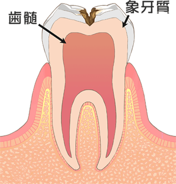 C2［象牙質の虫歯］