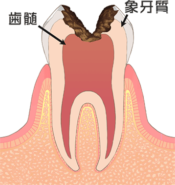C3［神経の虫歯］