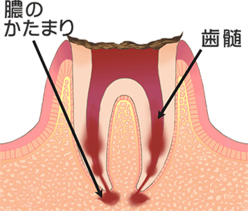 C4［末期の虫歯］