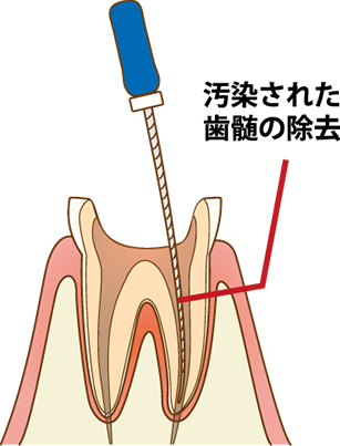 根管治療の流れ